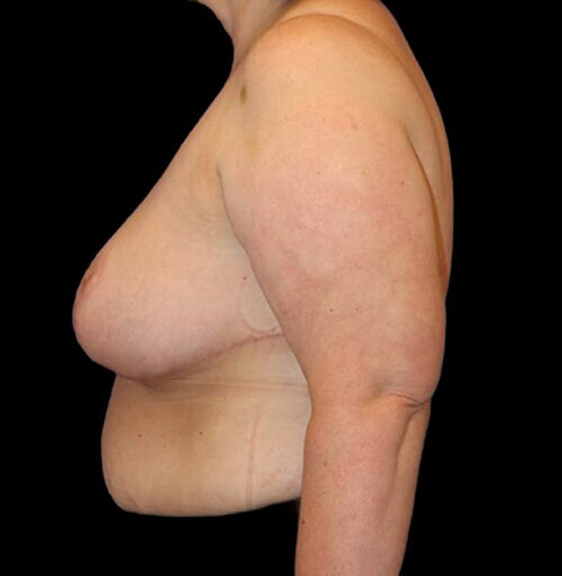 Breast Reduction Before & After Gallery - Patient 157688 - Image 6
