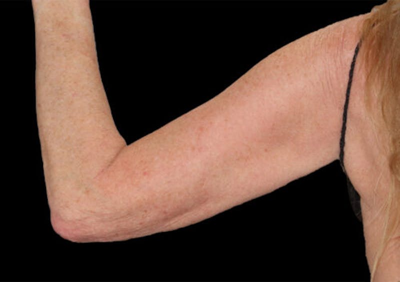 Brachioplasty (Arm Lift) Before & After Gallery - Patient 285631 - Image 1