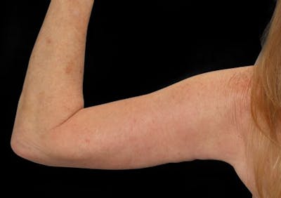 Brachioplasty (Arm Lift) Before & After Gallery - Patient 285631 - Image 2
