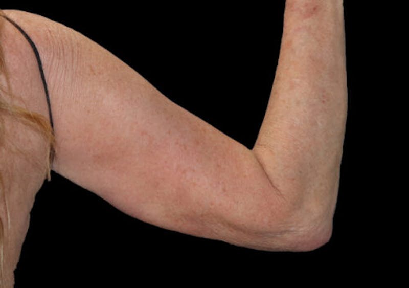 Brachioplasty (Arm Lift) Before & After Gallery - Patient 285631 - Image 3