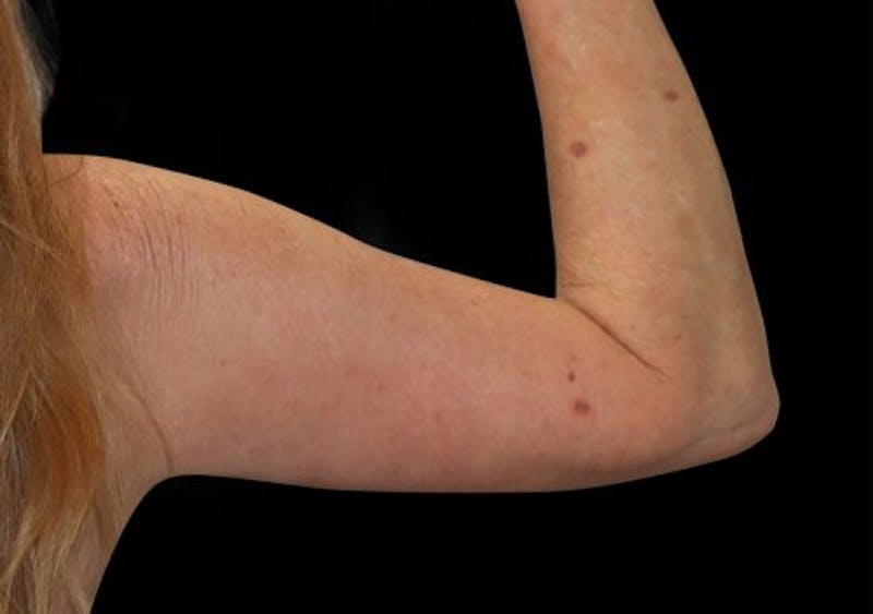 Brachioplasty (Arm Lift) Before & After Gallery - Patient 285631 - Image 4