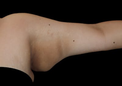Brachioplasty (Arm Lift) Before & After Gallery - Patient 305268 - Image 1