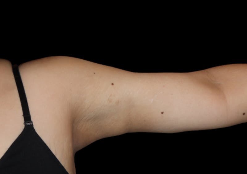 Brachioplasty (Arm Lift) Before & After Gallery - Patient 305268 - Image 2