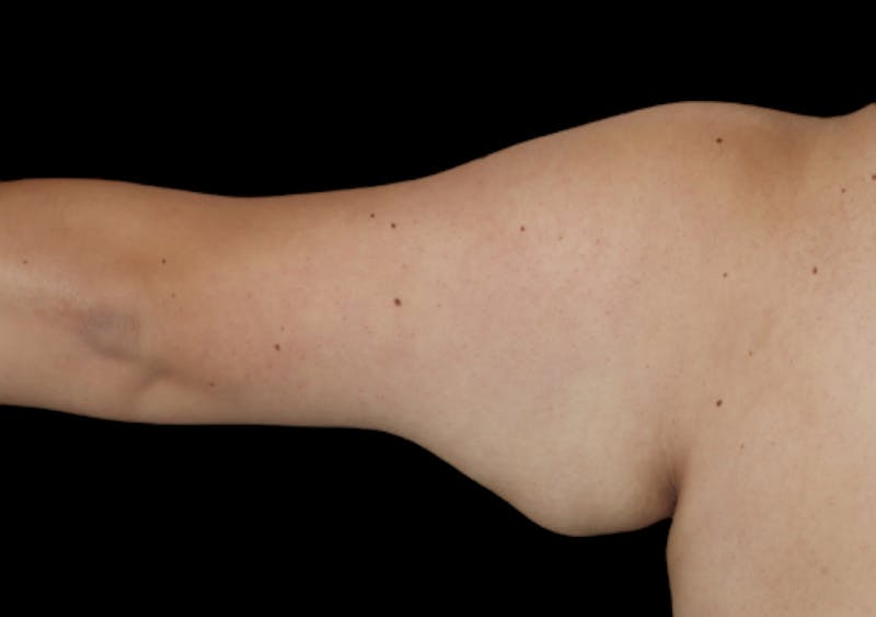 Brachioplasty (Arm Lift) Before & After Gallery - Patient 305268 - Image 3