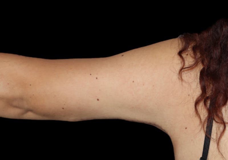 Brachioplasty (Arm Lift) Before & After Gallery - Patient 305268 - Image 4