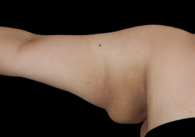 Brachioplasty (Arm Lift) Before & After Gallery - Patient 305268 - Image 5