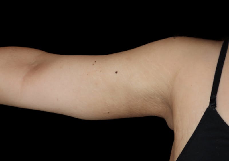 Brachioplasty (Arm Lift) Before & After Gallery - Patient 305268 - Image 6