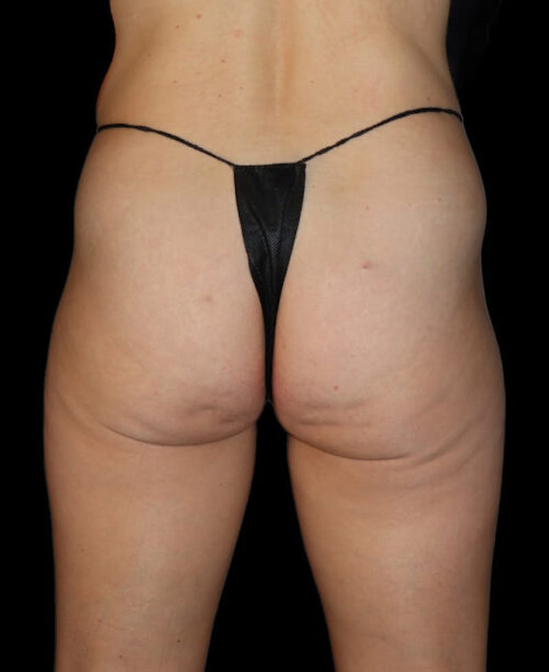 Miami Thong Lift Before & After Gallery - Patient 172369 - Image 1