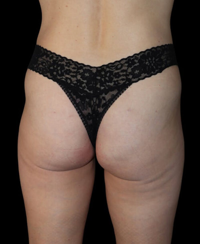 Miami Thong Lift Before & After Gallery - Patient 172369 - Image 2