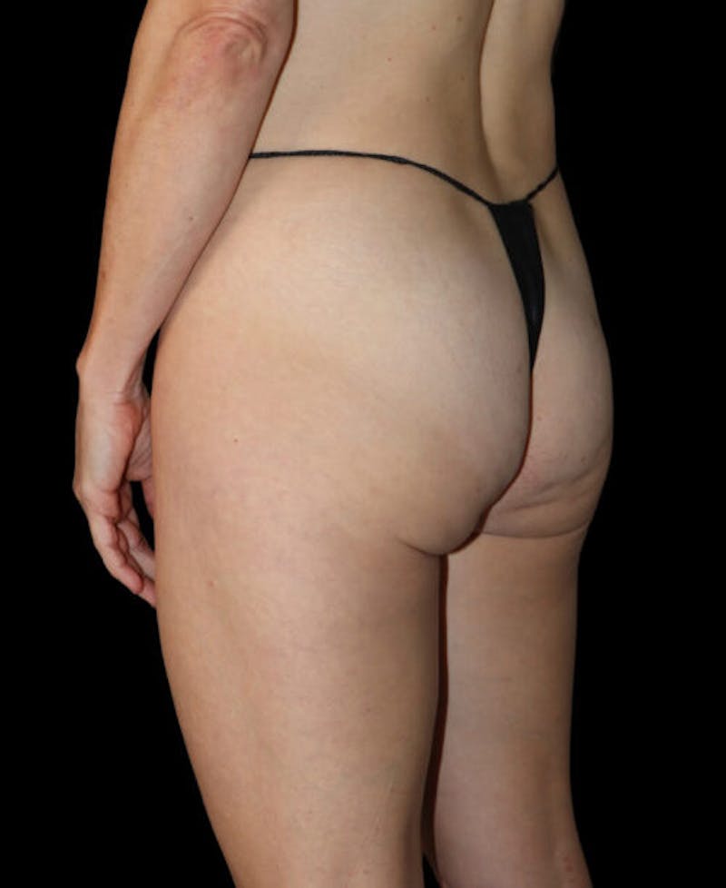 Miami Thong Lift Before & After Gallery - Patient 172369 - Image 3