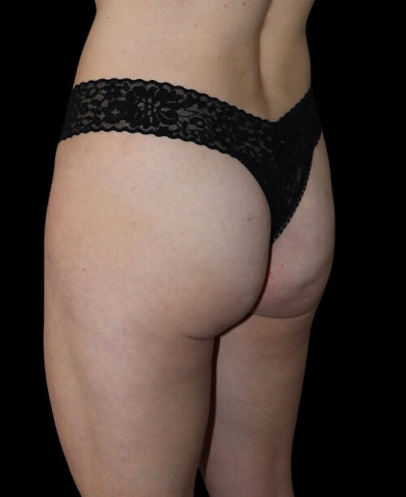 Miami Thong Lift Before & After Gallery - Patient 172369 - Image 4