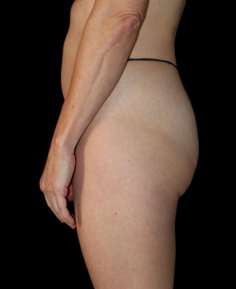 Miami Thong Lift Before & After Gallery - Patient 172369 - Image 5