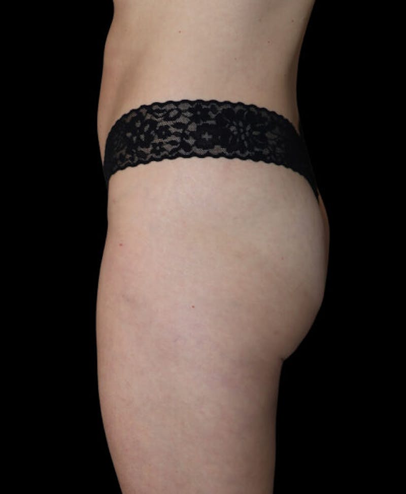 Miami Thong Lift Before & After Gallery - Patient 172369 - Image 6