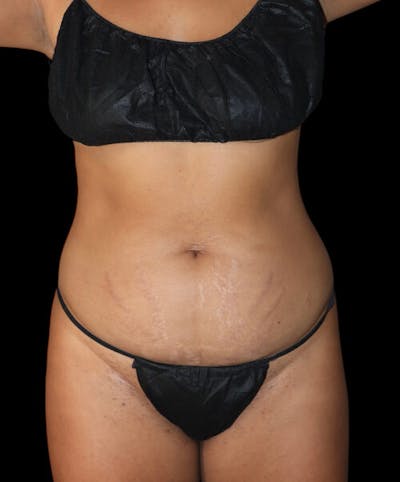 Abdominoplasty (Tummy Tuck) Before & After Gallery - Patient 427716 - Image 1