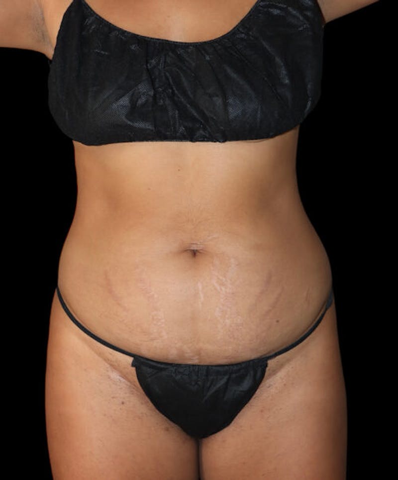 Abdominoplasty (Tummy Tuck) Before & After Gallery - Patient 427716 - Image 1
