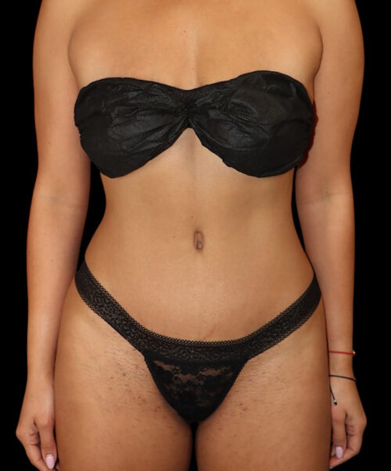 Abdominoplasty (Tummy Tuck) Before & After Gallery - Patient 427716 - Image 2