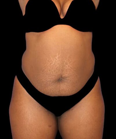 Abdominoplasty (Tummy Tuck) Before & After Gallery - Patient 125416 - Image 1