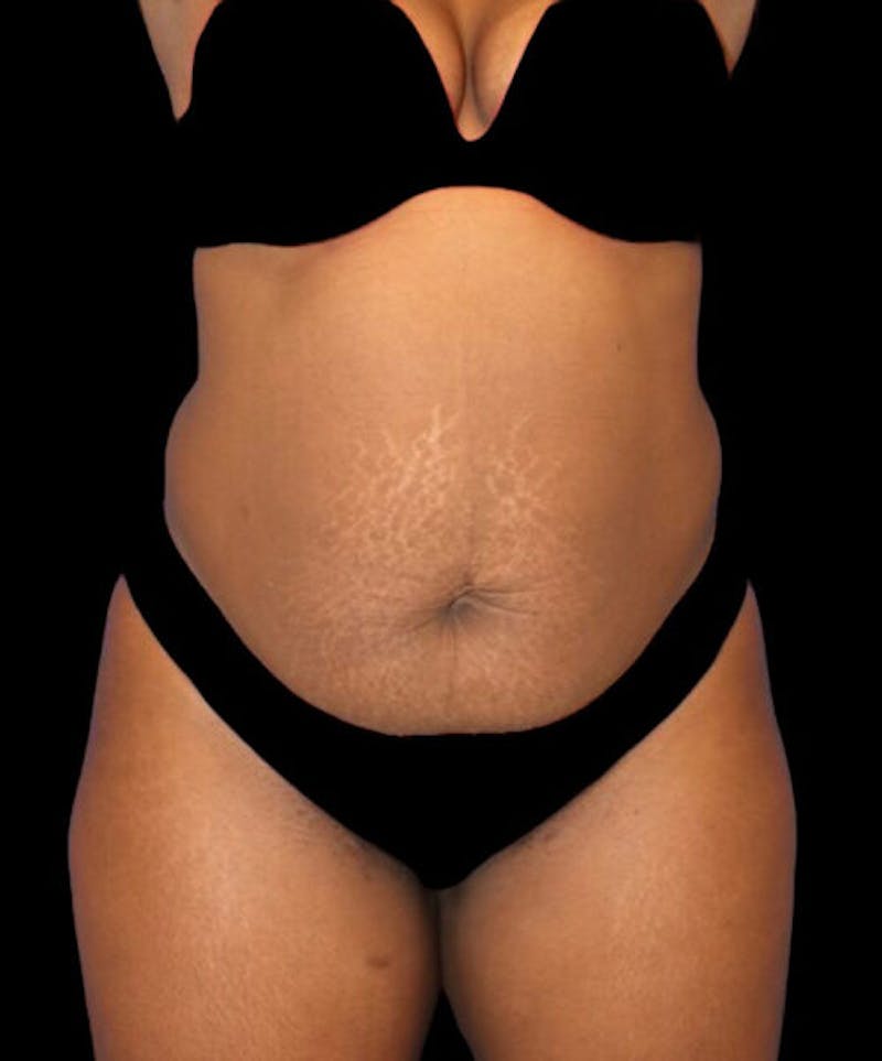 Abdominoplasty (Tummy Tuck) Before & After Gallery - Patient 125416 - Image 1