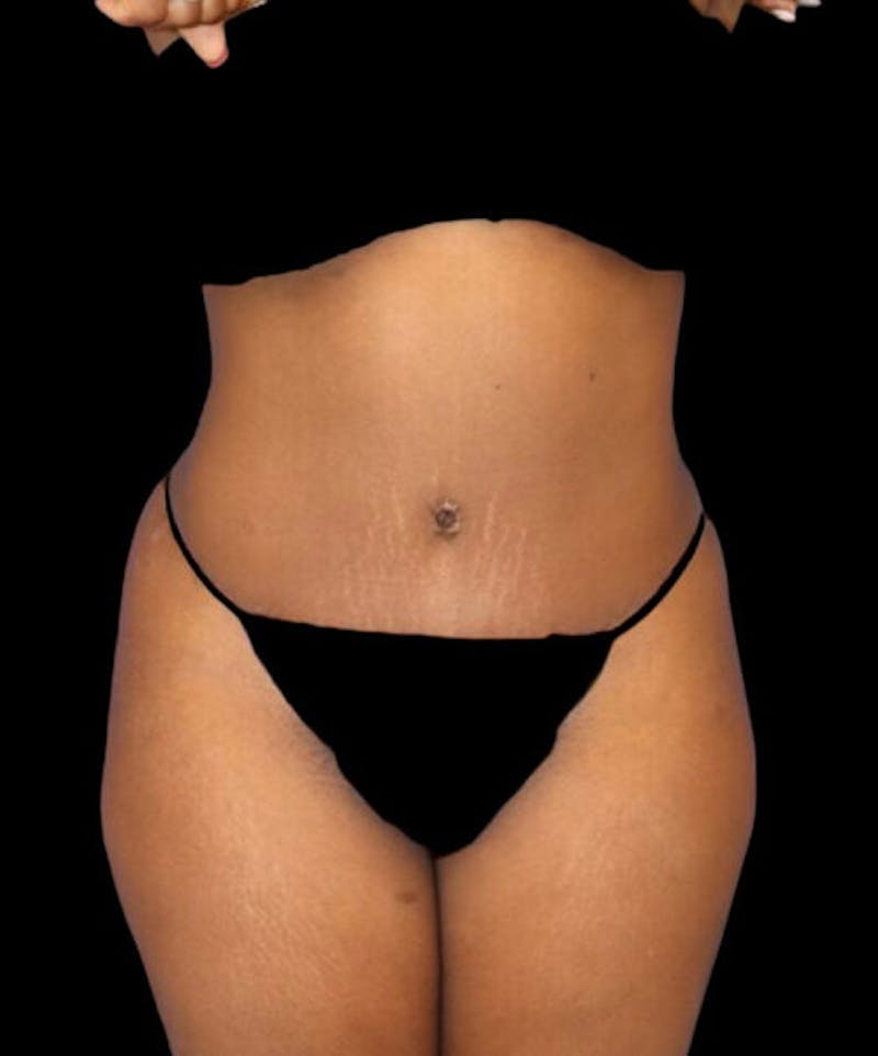Abdominoplasty (Tummy Tuck) Before & After Gallery - Patient 125416 - Image 2