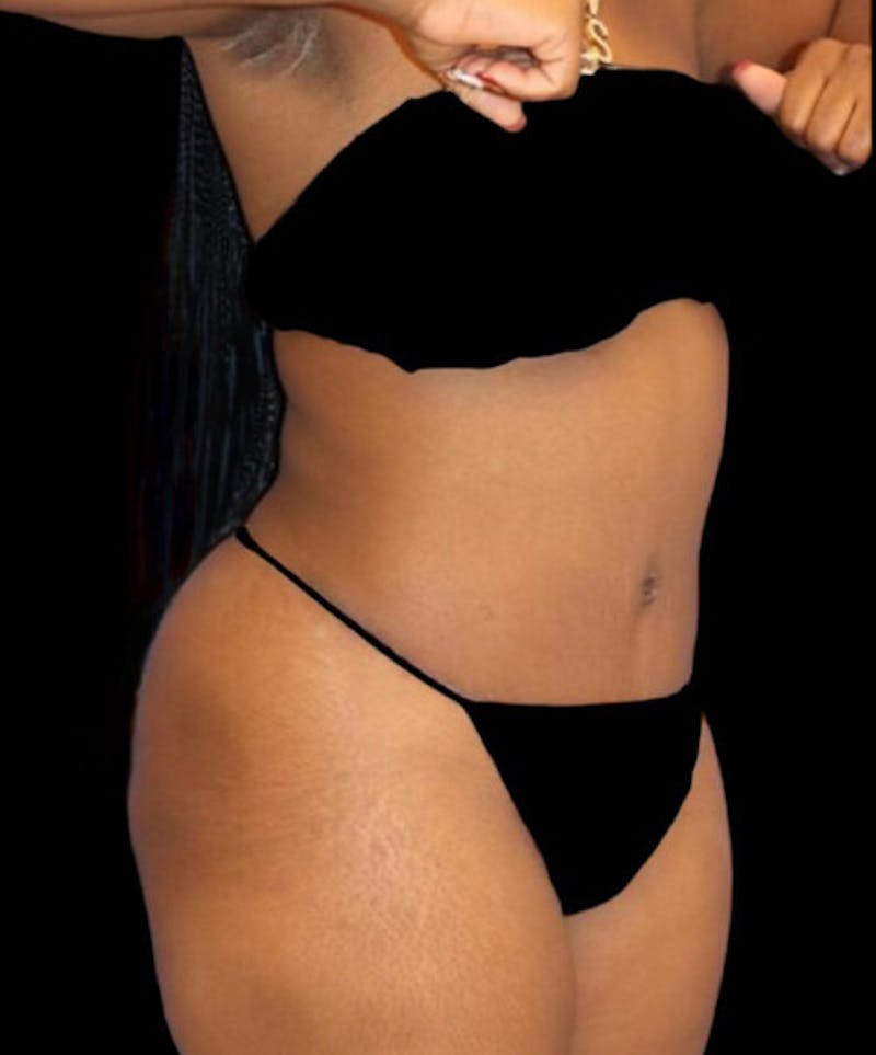 Abdominoplasty (Tummy Tuck) Before & After Gallery - Patient 125416 - Image 4