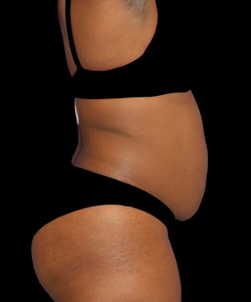 Abdominoplasty (Tummy Tuck) Before & After Gallery - Patient 125416 - Image 5
