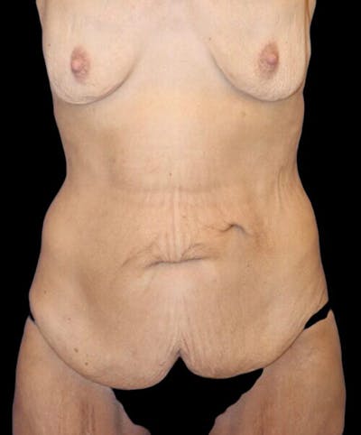 Abdominoplasty (Tummy Tuck) Before & After Gallery - Patient 315002 - Image 1
