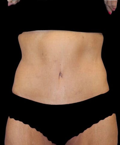 Abdominoplasty (Tummy Tuck) Before & After Gallery - Patient 315002 - Image 2