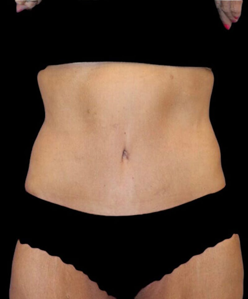 Abdominoplasty (Tummy Tuck) Before & After Gallery - Patient 315002 - Image 2