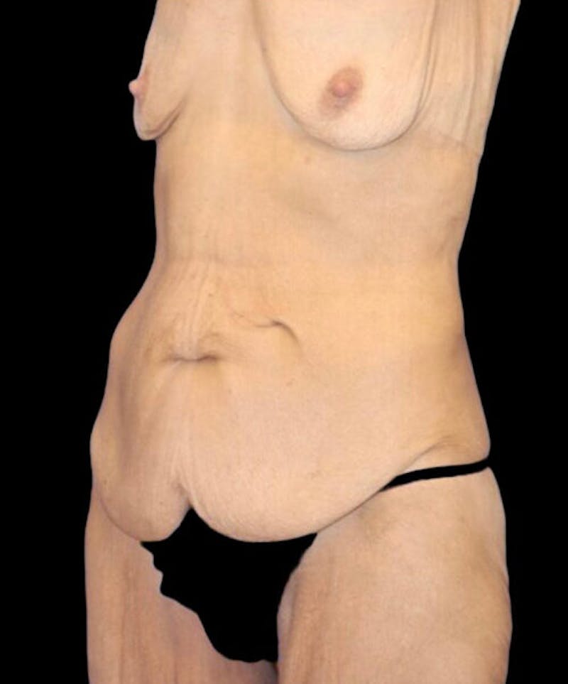 Abdominoplasty (Tummy Tuck) Before & After Gallery - Patient 315002 - Image 3