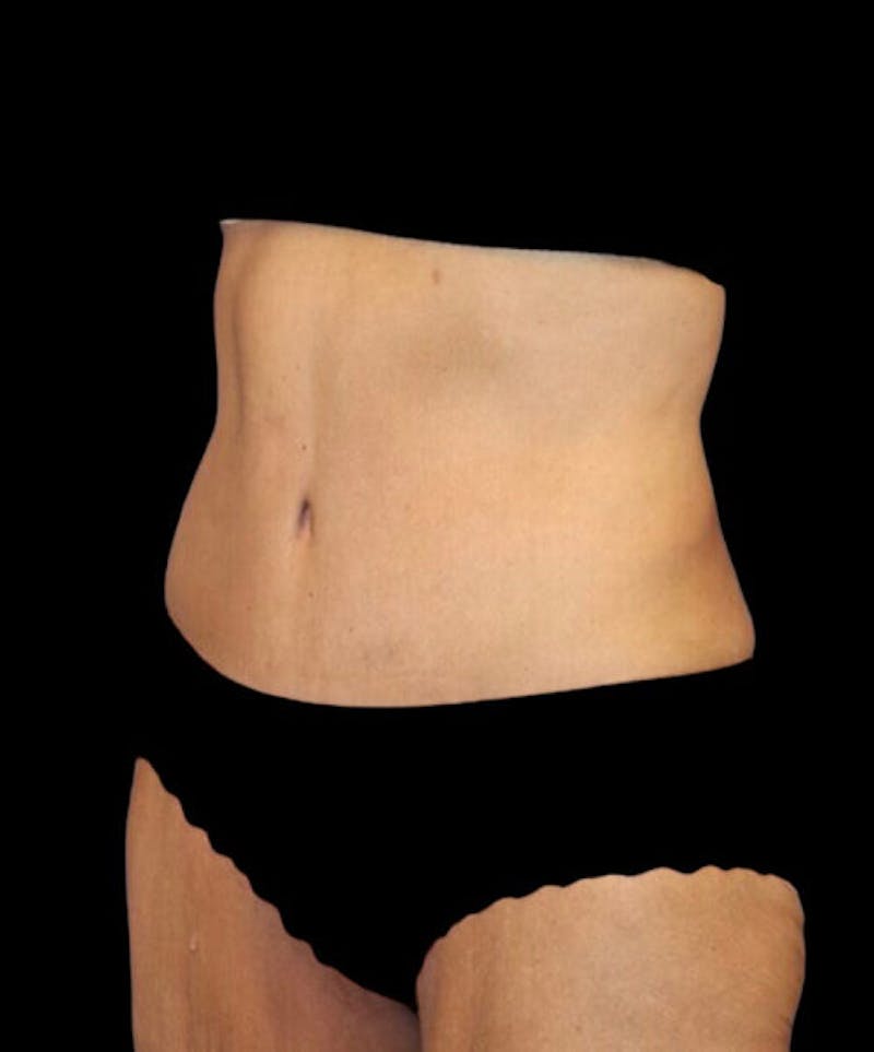 Abdominoplasty (Tummy Tuck) Before & After Gallery - Patient 315002 - Image 4