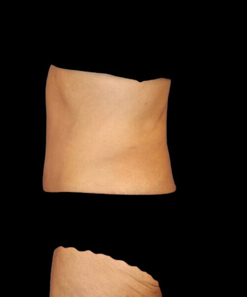 Abdominoplasty (Tummy Tuck) Before & After Gallery - Patient 315002 - Image 6