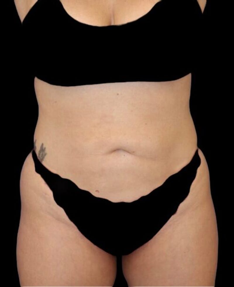 Abdominoplasty (Tummy Tuck) Before & After Gallery - Patient 288789 - Image 1