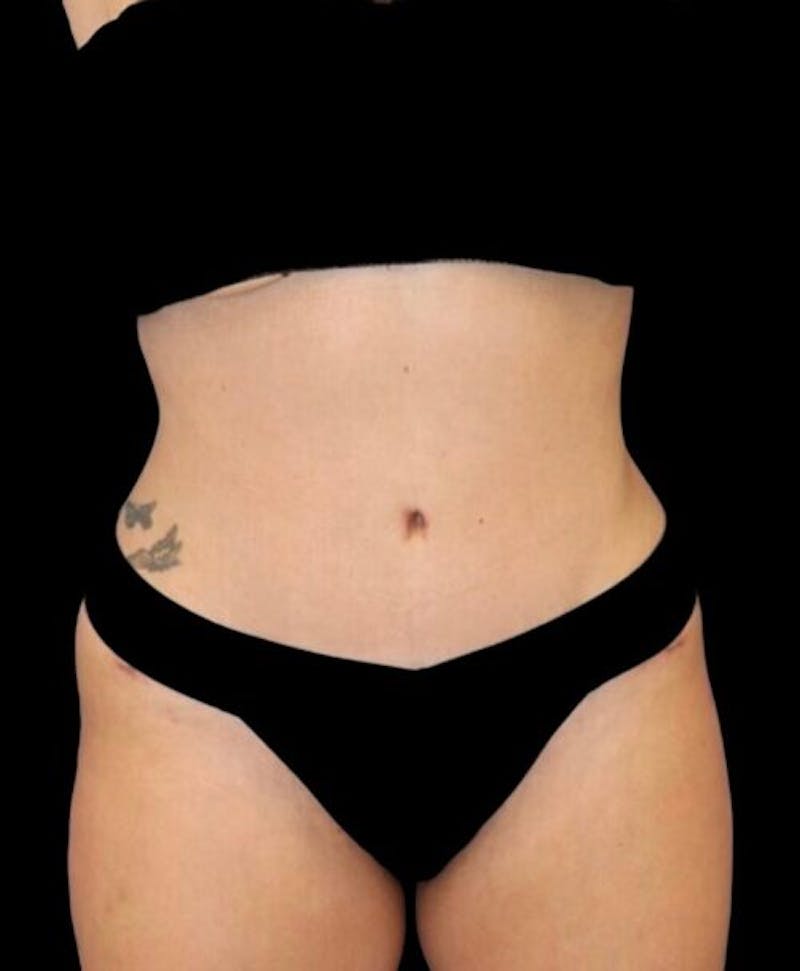 Abdominoplasty (Tummy Tuck) Before & After Gallery - Patient 288789 - Image 2