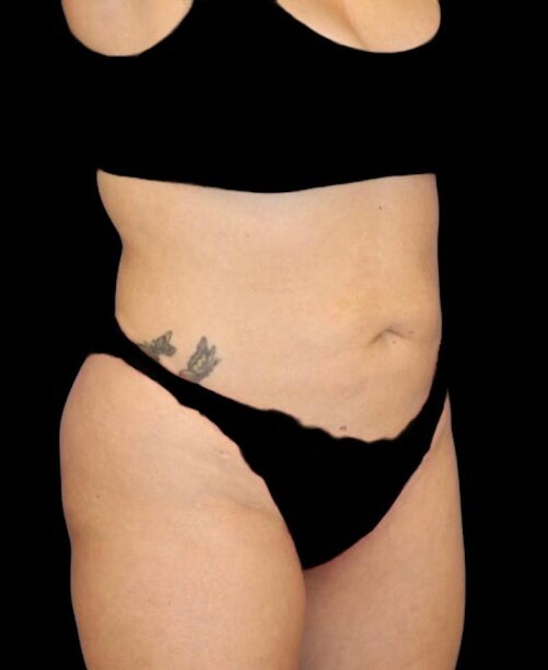 Abdominoplasty (Tummy Tuck) Before & After Gallery - Patient 288789 - Image 3