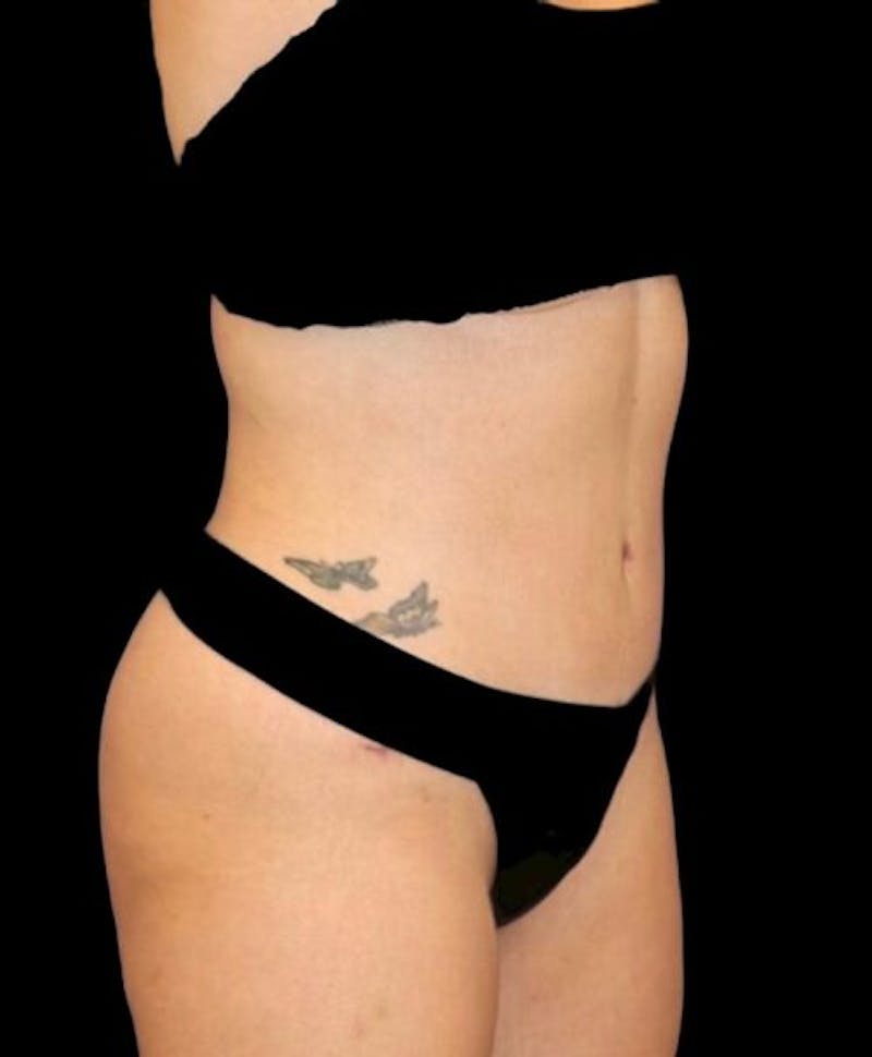 Abdominoplasty (Tummy Tuck) Before & After Gallery - Patient 288789 - Image 4