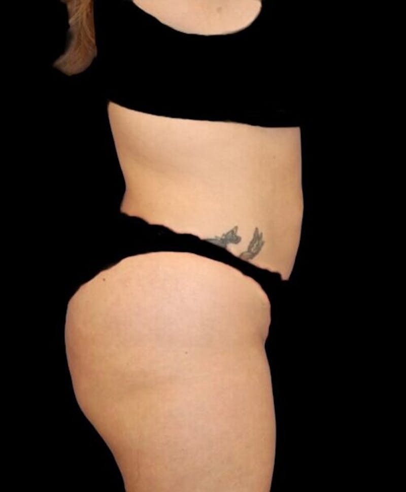 Abdominoplasty (Tummy Tuck) Before & After Gallery - Patient 288789 - Image 5