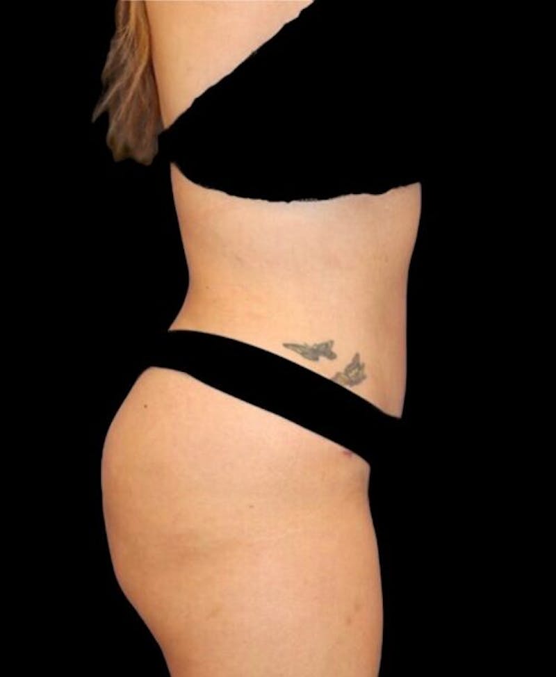 Abdominoplasty (Tummy Tuck) Before & After Gallery - Patient 288789 - Image 6