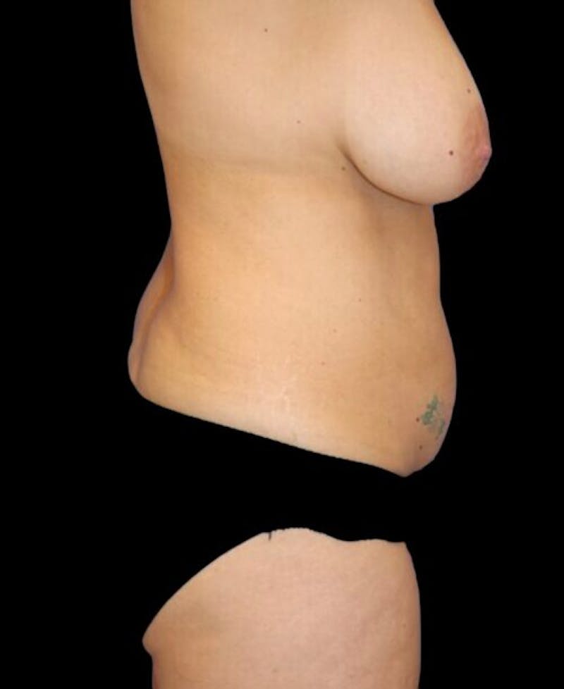 Abdominoplasty (Tummy Tuck) Before & After Gallery - Patient 112311 - Image 5