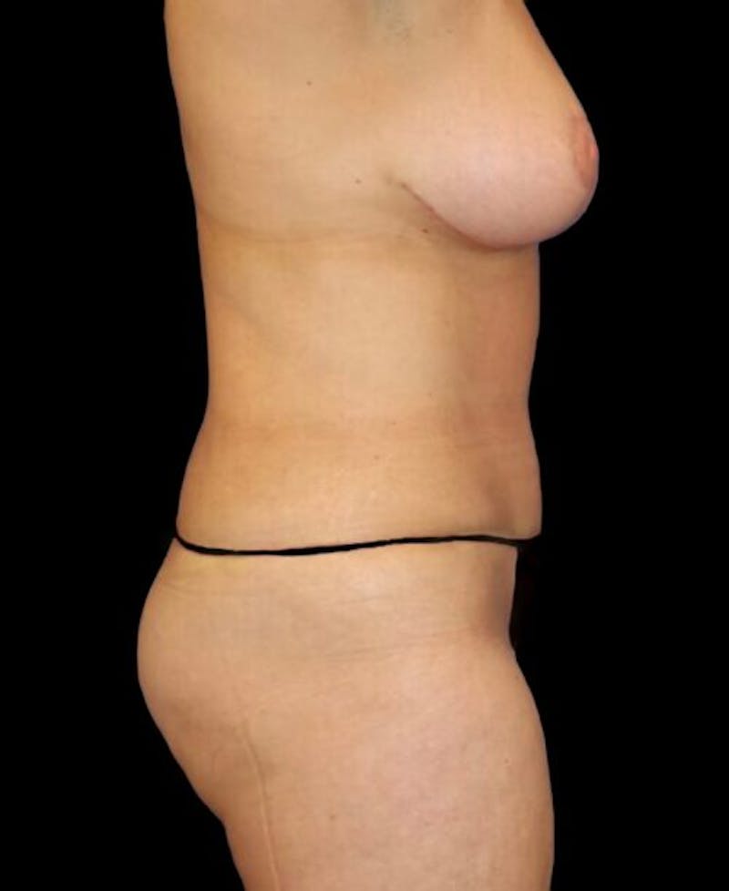 Abdominoplasty (Tummy Tuck) Before & After Gallery - Patient 112311 - Image 6