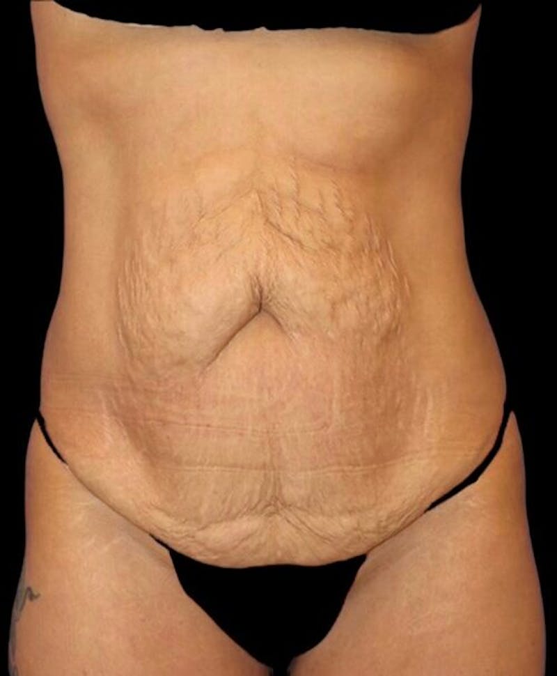 Abdominoplasty (Tummy Tuck) Before & After Gallery - Patient 392844 - Image 1