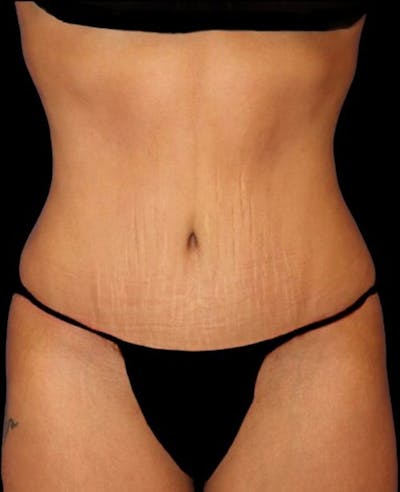 Abdominoplasty (Tummy Tuck) Before & After Gallery - Patient 392844 - Image 2