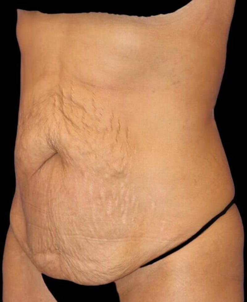 Abdominoplasty (Tummy Tuck) Before & After Gallery - Patient 392844 - Image 3