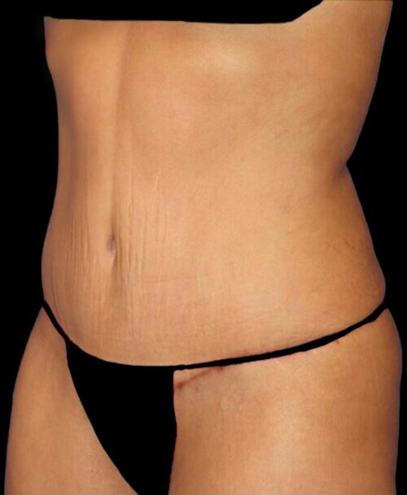 Abdominoplasty (Tummy Tuck) Before & After Gallery - Patient 392844 - Image 4