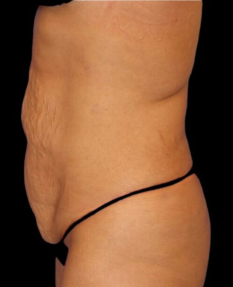 Abdominoplasty (Tummy Tuck) Before & After Gallery - Patient 392844 - Image 5