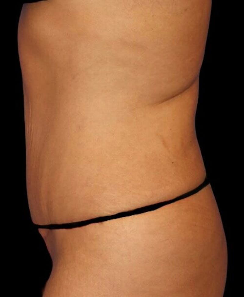 Abdominoplasty (Tummy Tuck) Before & After Gallery - Patient 392844 - Image 6