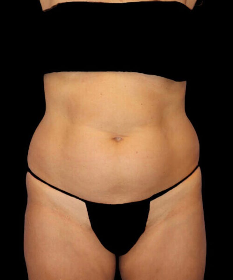 Abdominoplasty (Tummy Tuck) Before & After Gallery - Patient 294791 - Image 1