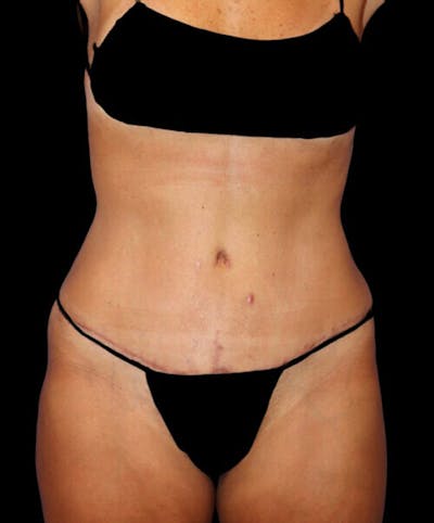 Abdominoplasty (Tummy Tuck) Before & After Gallery - Patient 294791 - Image 2