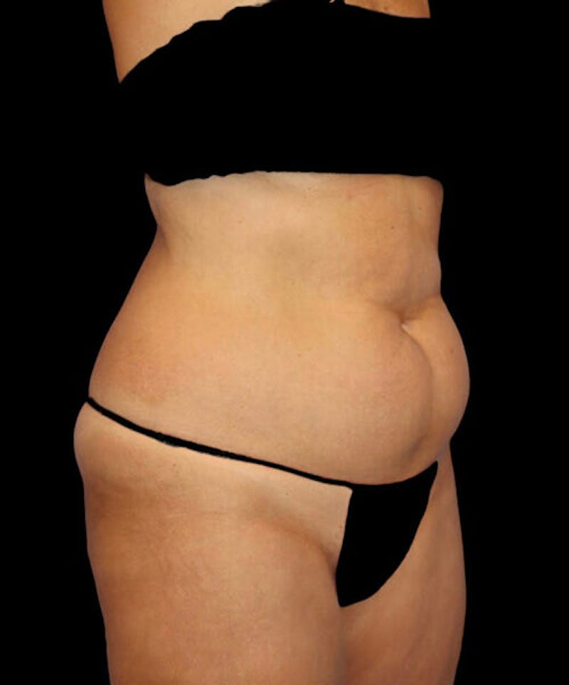 Abdominoplasty (Tummy Tuck) Before & After Gallery - Patient 294791 - Image 3