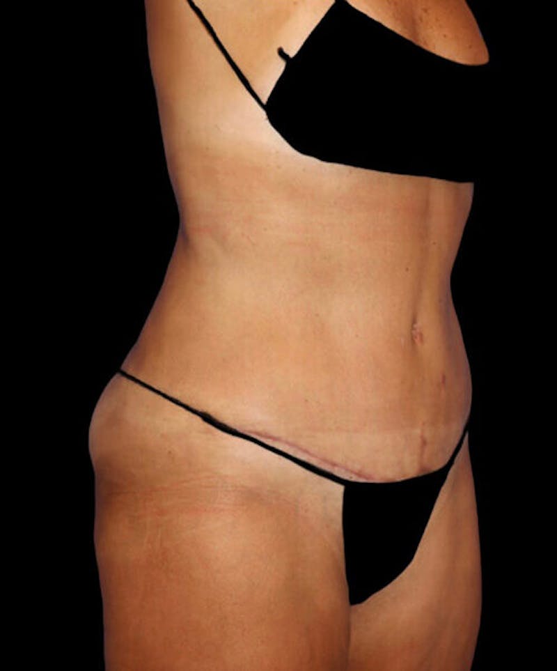 Abdominoplasty (Tummy Tuck) Before & After Gallery - Patient 294791 - Image 4