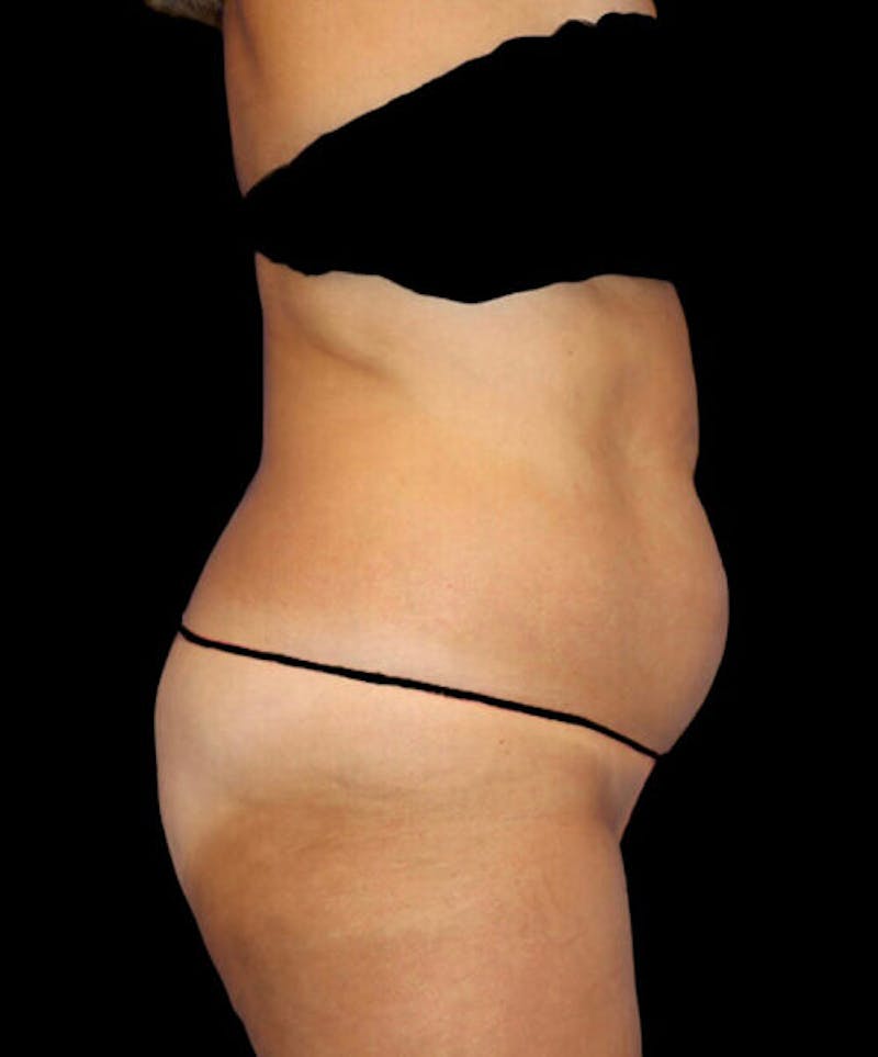 Abdominoplasty (Tummy Tuck) Before & After Gallery - Patient 294791 - Image 5